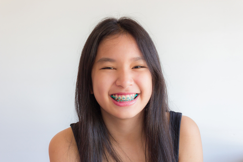 Traditional Metal Braces in Austin